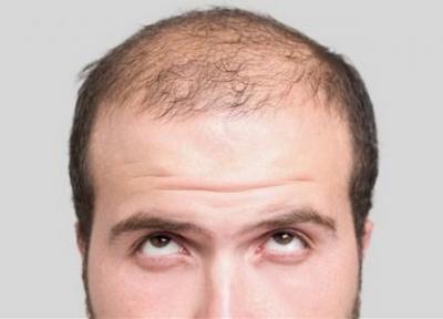 ریزش مو و 7 روش درمان طبیعی آن در منزل